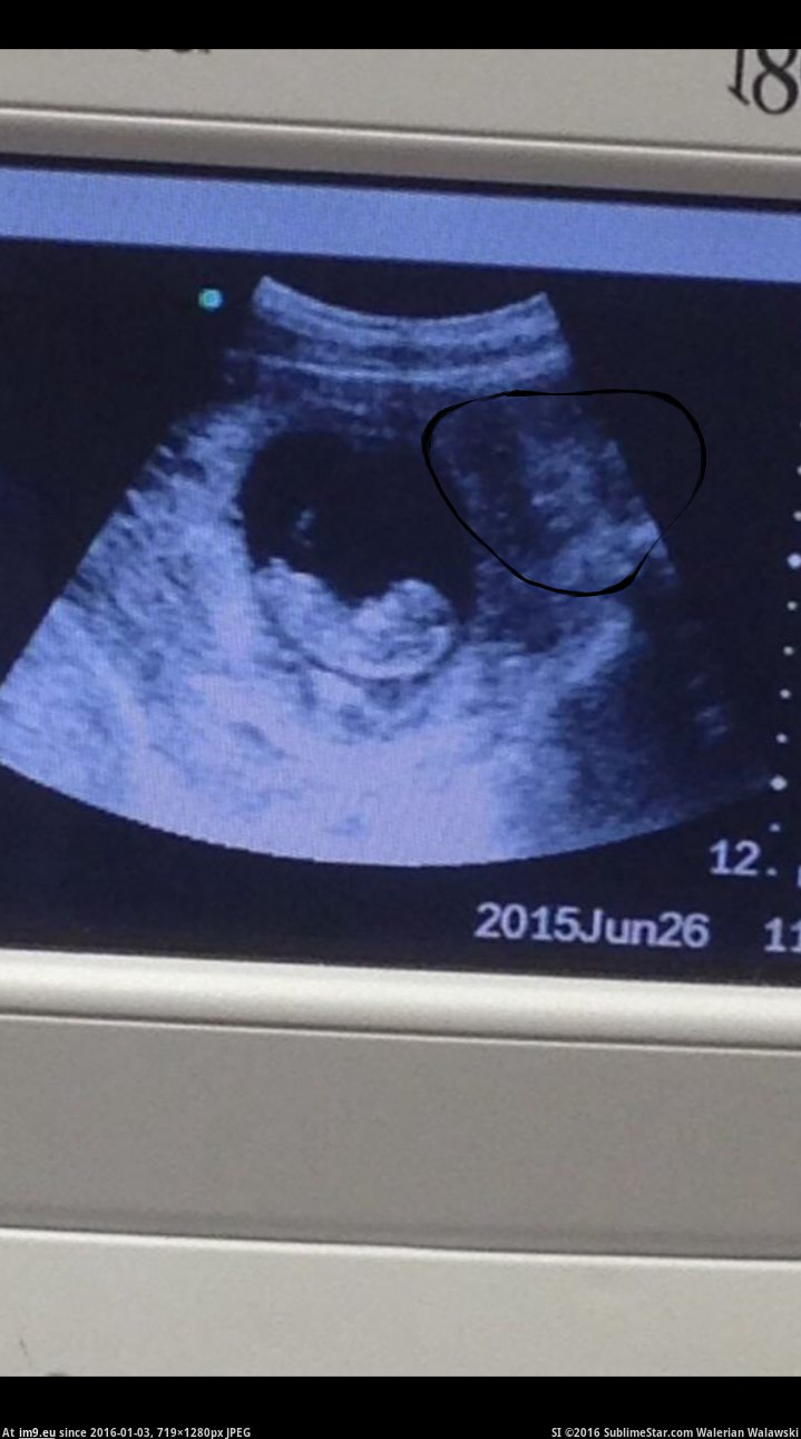 Alternative-News.tk - Chilling picture shows what some are saying is a  'demon' watching over unborn baby in a ultrasound