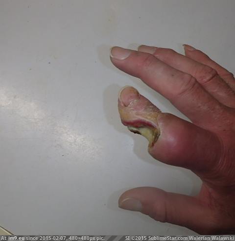 [Wtf] Progression of a western diamondback rattlesnake bite NSFW 11 (in My r/WTF favs)