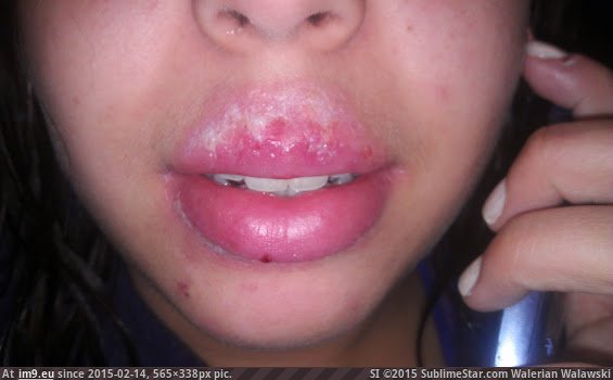 [Wtf] The Cold Sore(s) that took over my face for 2 weeks. [NSFW] Don't screw with an Autoimmune Disorder 4 (in My r/WTF favs)