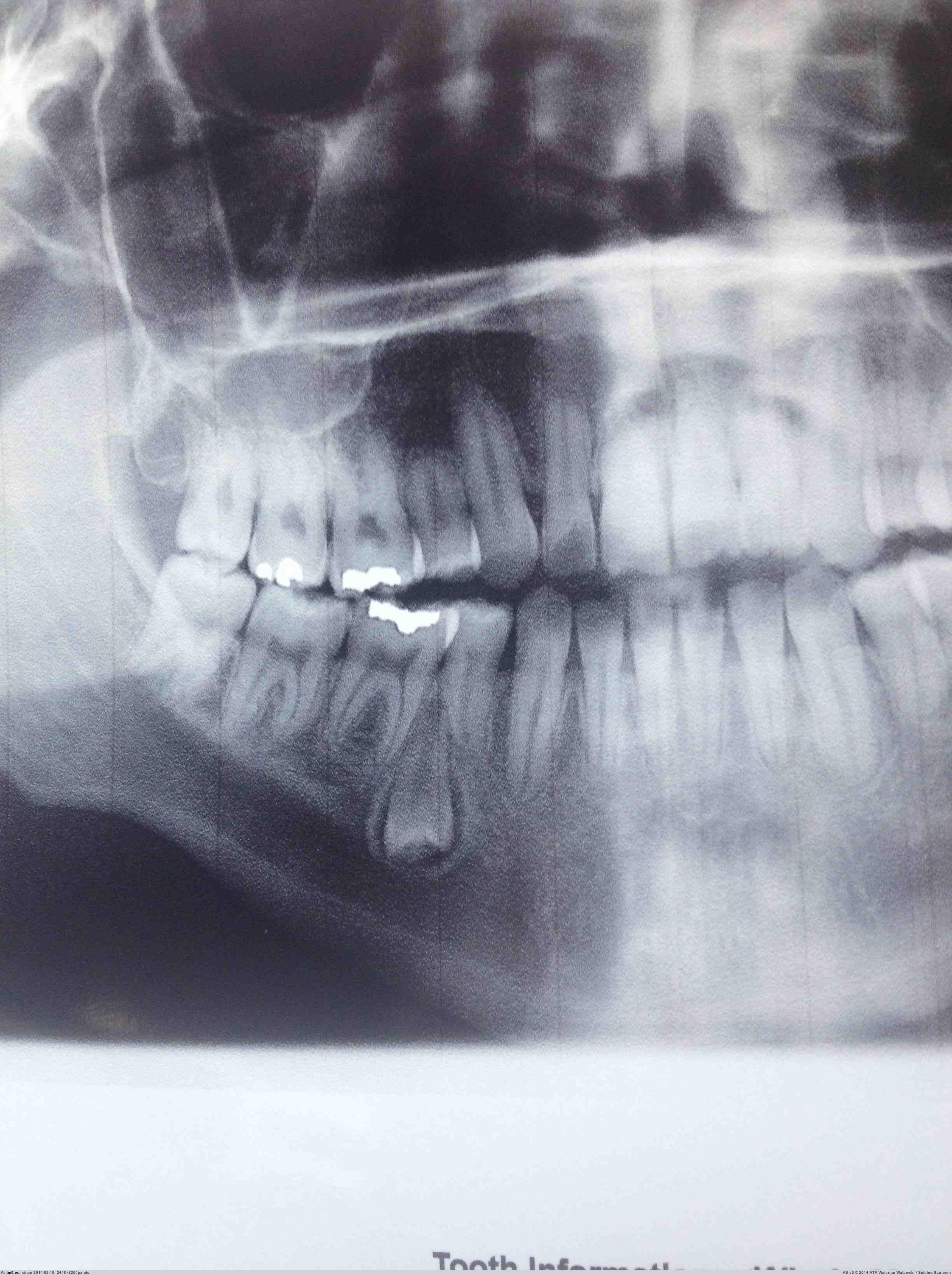 [Wtf] Went to the Dentist yesterday, they discovered a tooth growing upside down in my gums. (in My r/WTF favs)